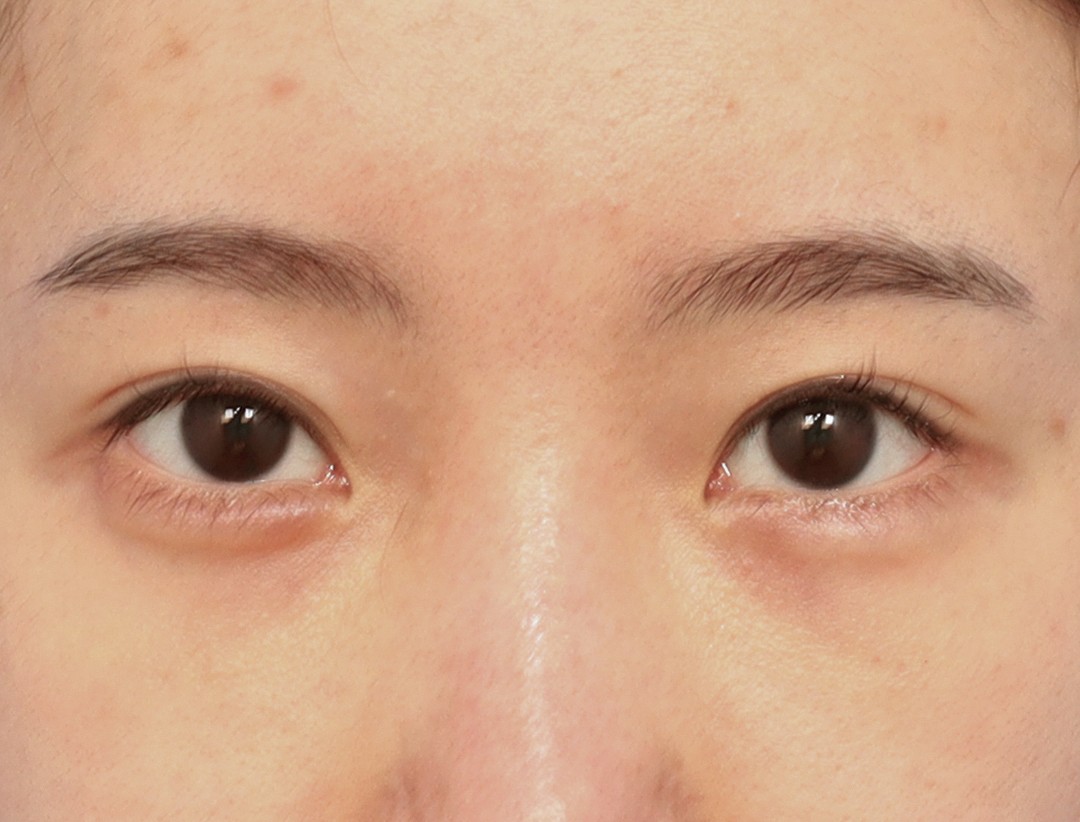 쌍꺼풀 Before