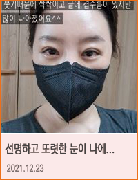 링크성형외과_케이스사진(네이버카페)리얼후기_리얼찐후기_네이버카페_후기리뷰_쌍꺼풀수술_7