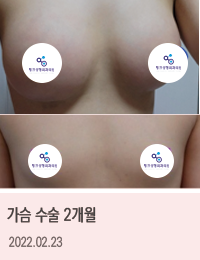 링크성형외과_케이스사진_18