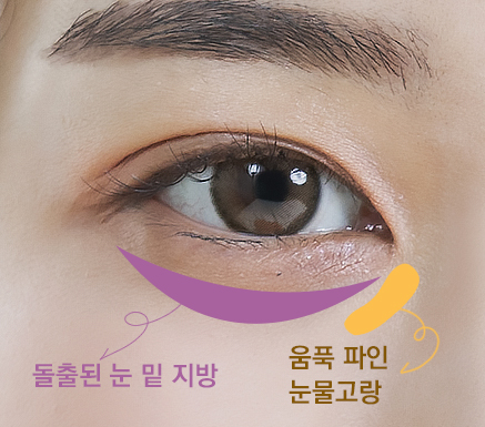 눈밑지방재배치_링크성형외과_눈밑지방재배치 비용_눈밑지방재배치 효과