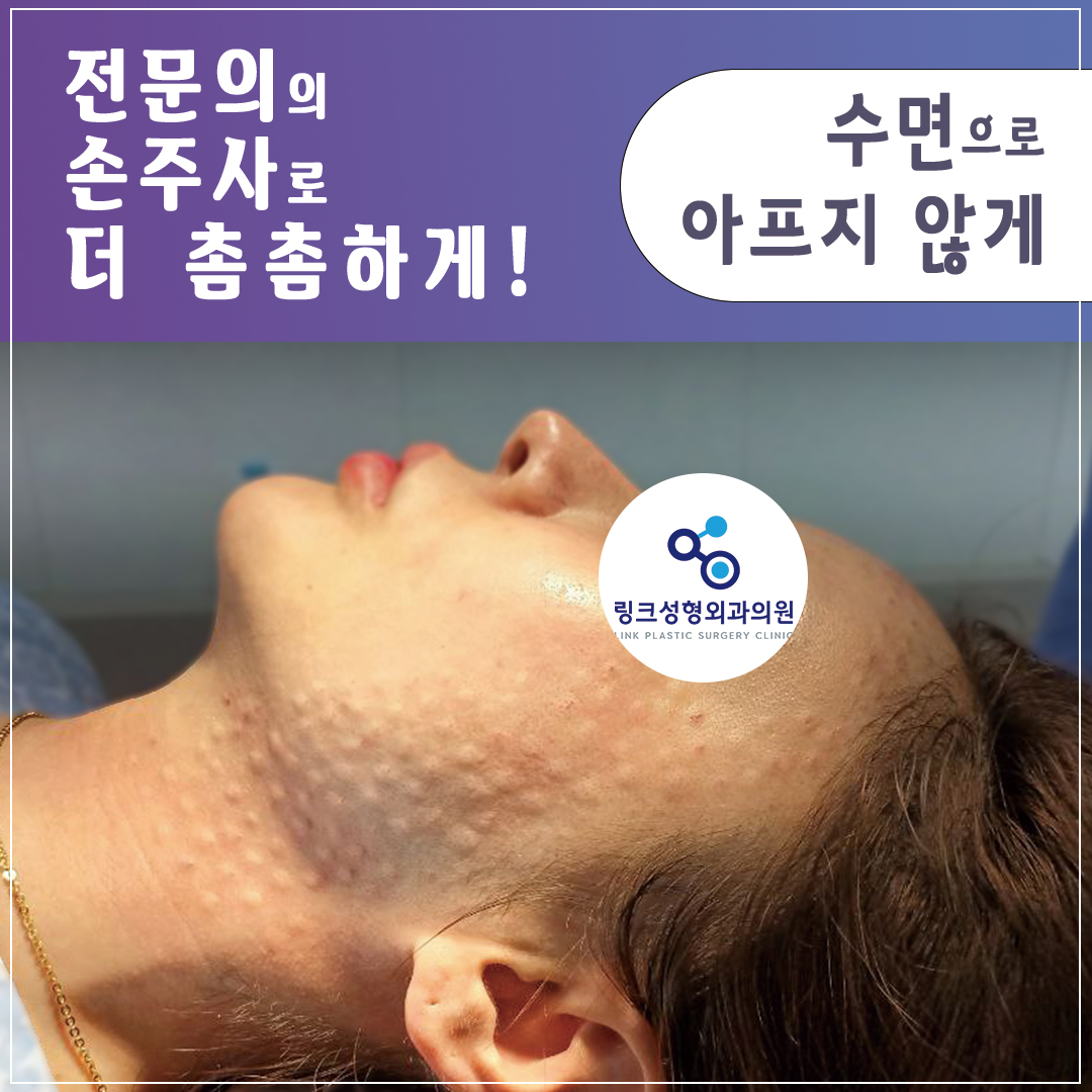 리쥬란_리쥬란힐러_수면리쥬란_리쥬란효과_리쥬란비용_1_리쥬란 실제 후기