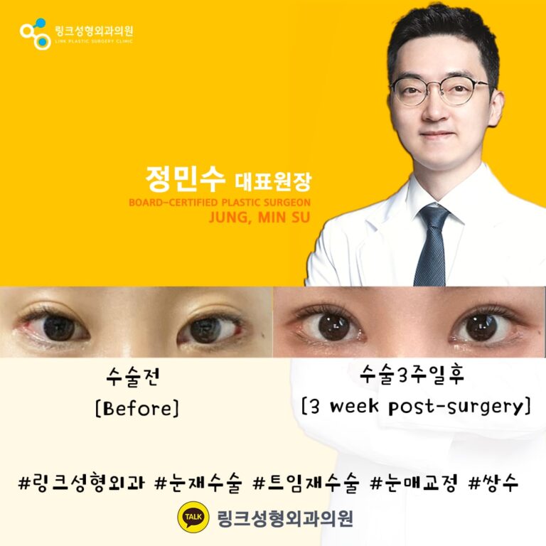 쌍꺼풀_쌍꺼풀수술_쌍커풀_쌍커풀수술1
