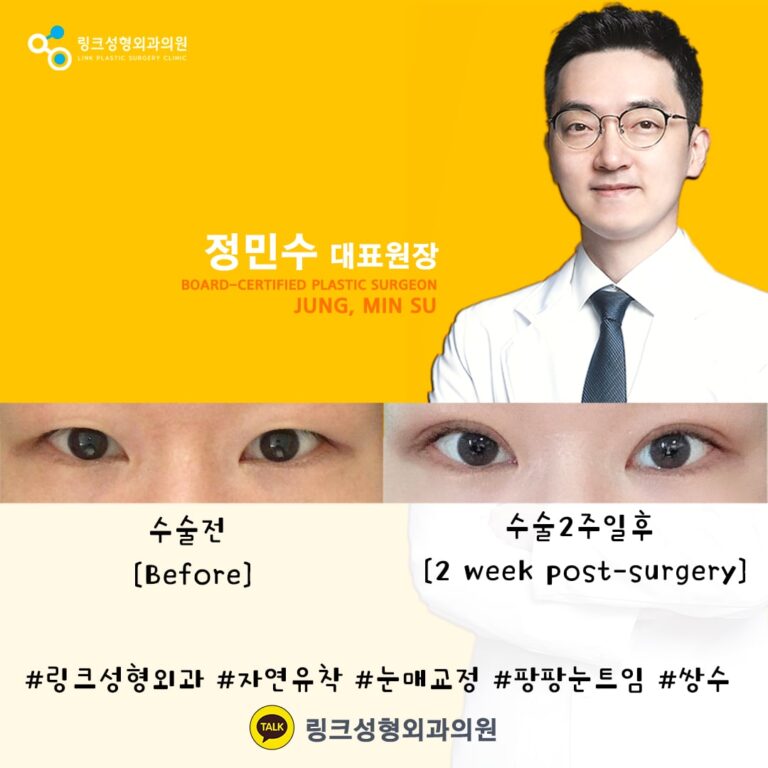 쌍꺼풀_쌍꺼풀수술_쌍커풀_쌍커풀수술2