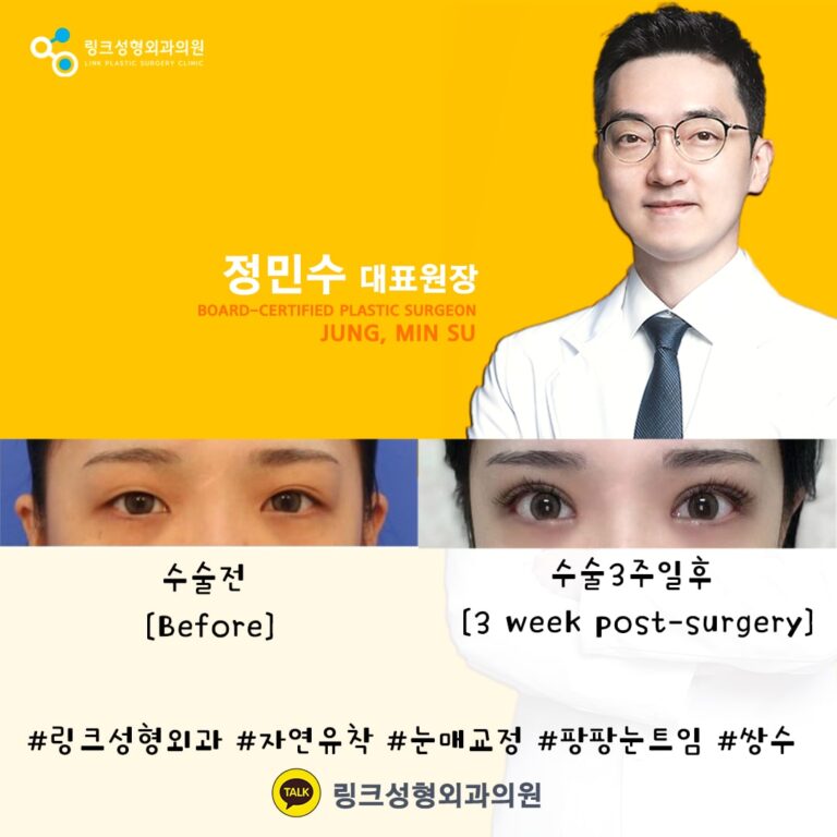 쌍꺼풀_쌍꺼풀수술_쌍커풀_쌍커풀수술3