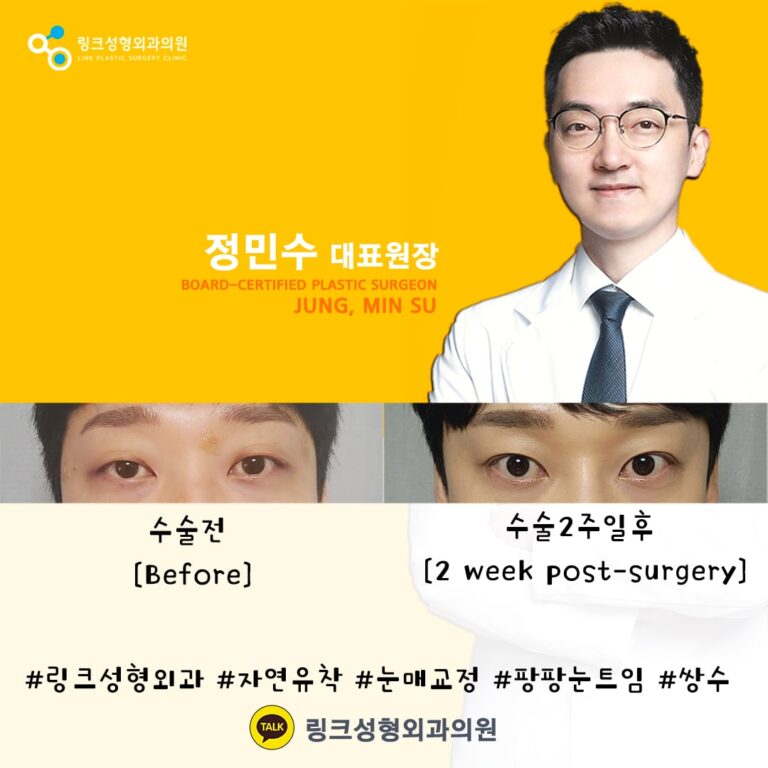 쌍꺼풀_쌍꺼풀수술_쌍커풀_쌍커풀수술4
