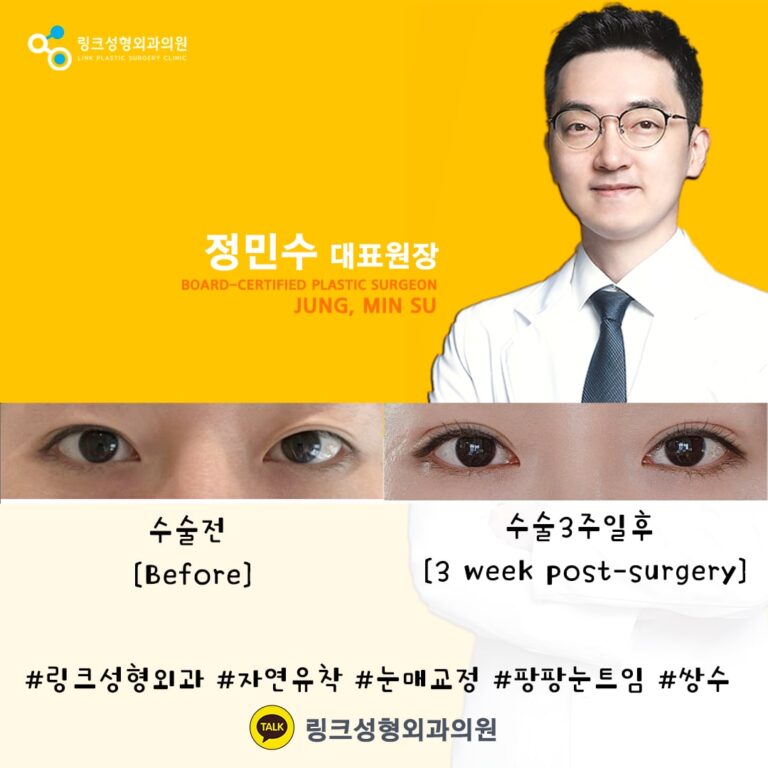 쌍꺼풀_쌍꺼풀수술_쌍커풀_쌍커풀수술5