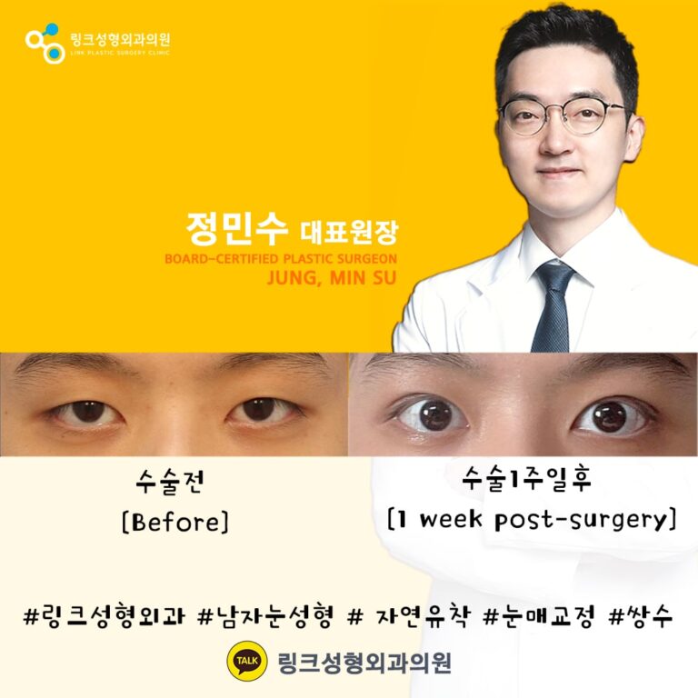 쌍꺼풀_쌍꺼풀수술_쌍커풀_쌍커풀수술6