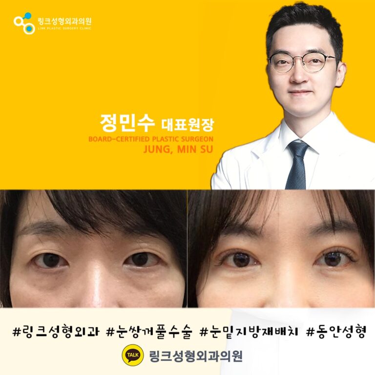 쌍꺼풀_쌍꺼풀수술_쌍커풀_쌍커풀수술7