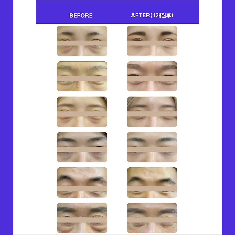 눈밑지방재배치 관련 이미지