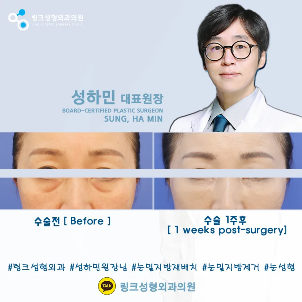 눈밑지방재배치 관련 이미지