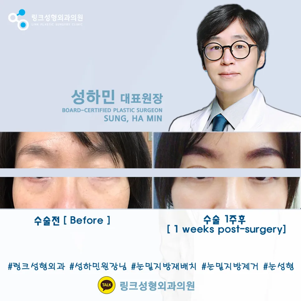 눈밑지방재배치 관련 이미지