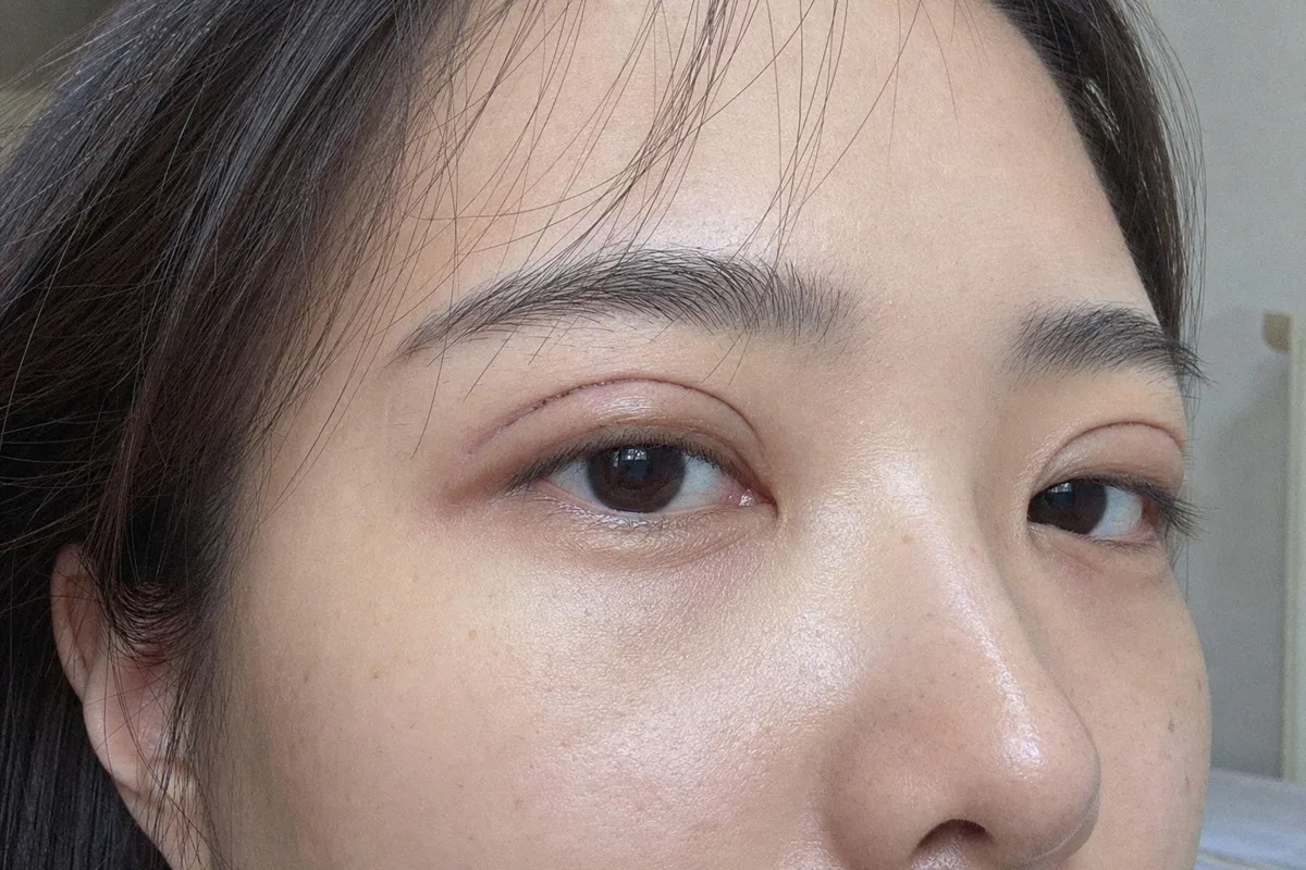 눈성형회복 관련 이미지