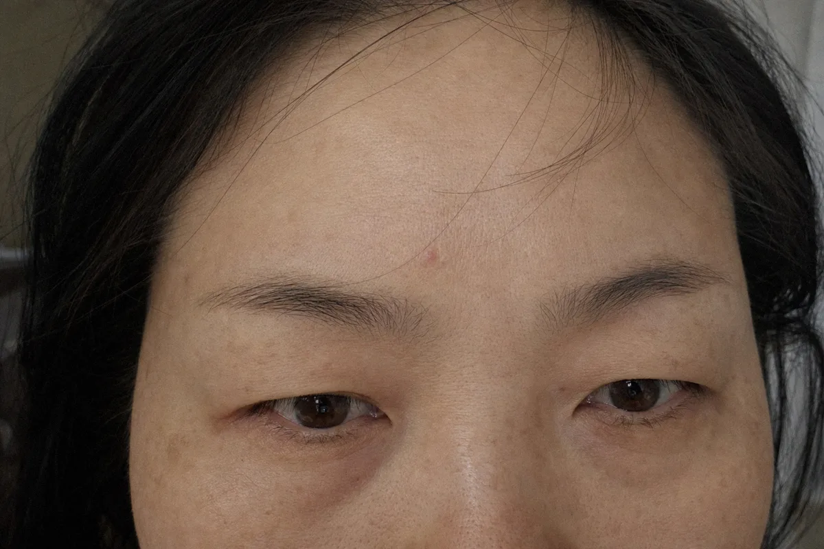 눈썹거상 관련 이미지