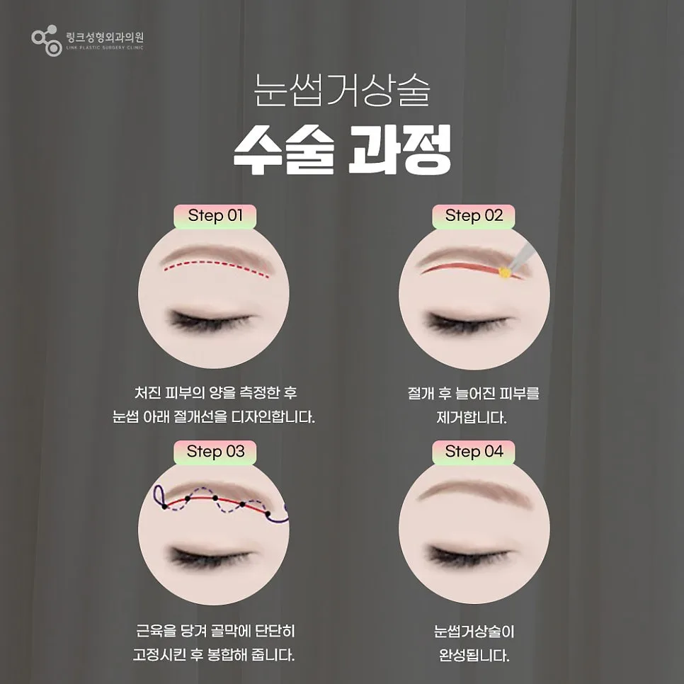 눈썹거상 관련 이미지