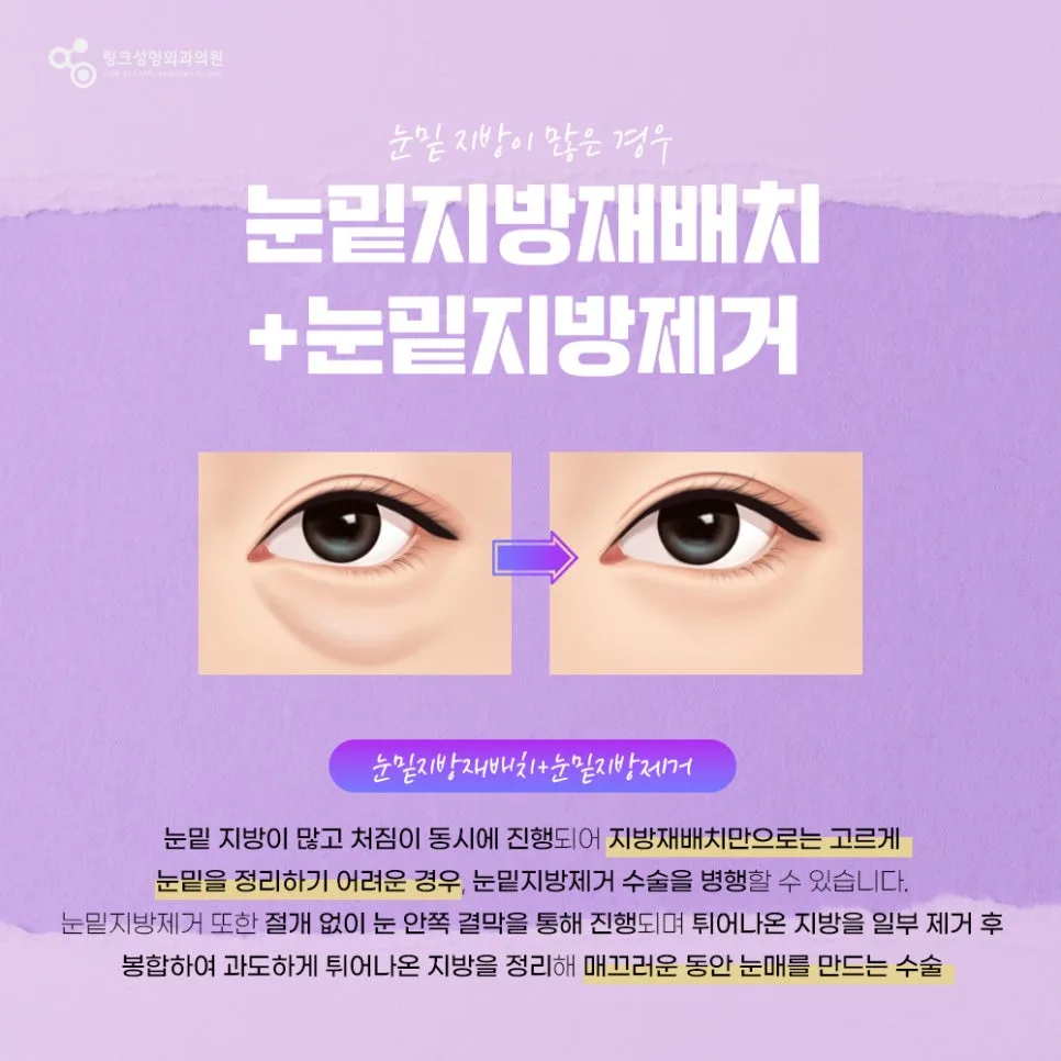 눈밑지방재배치 관련 이미지