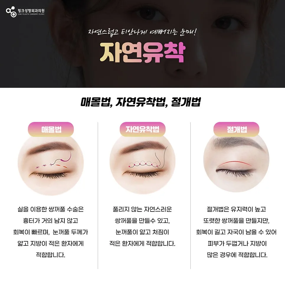 눈재수술 관련 이미지