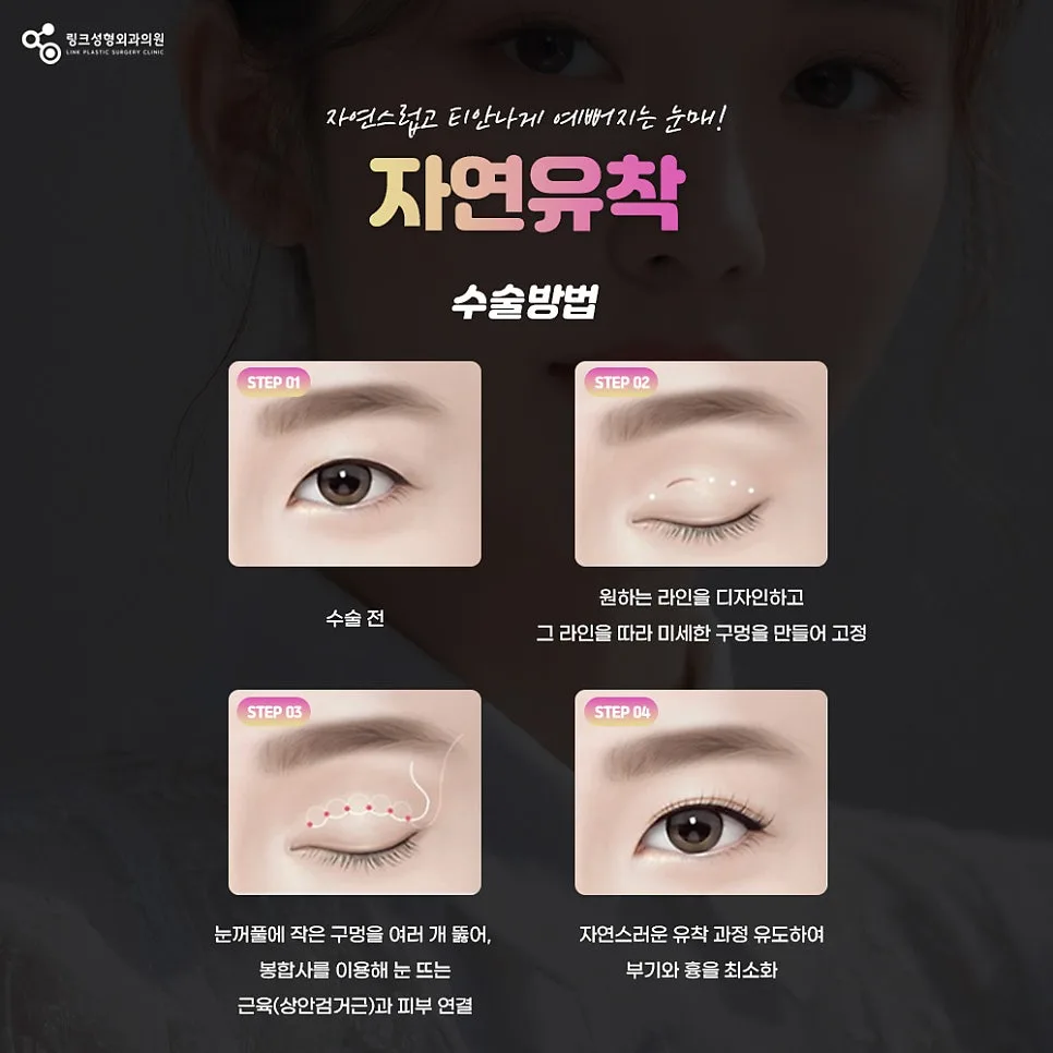 눈재수술 관련 이미지