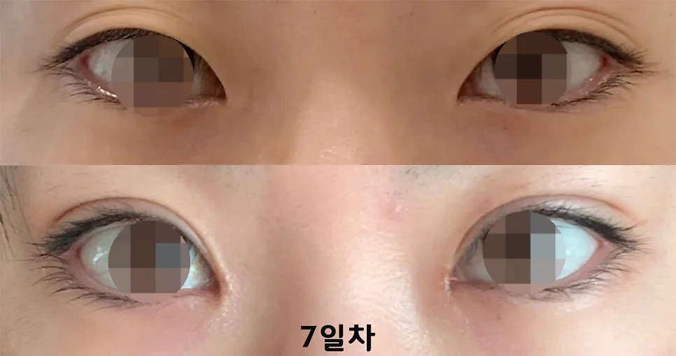 눈매교정 관련 이미지