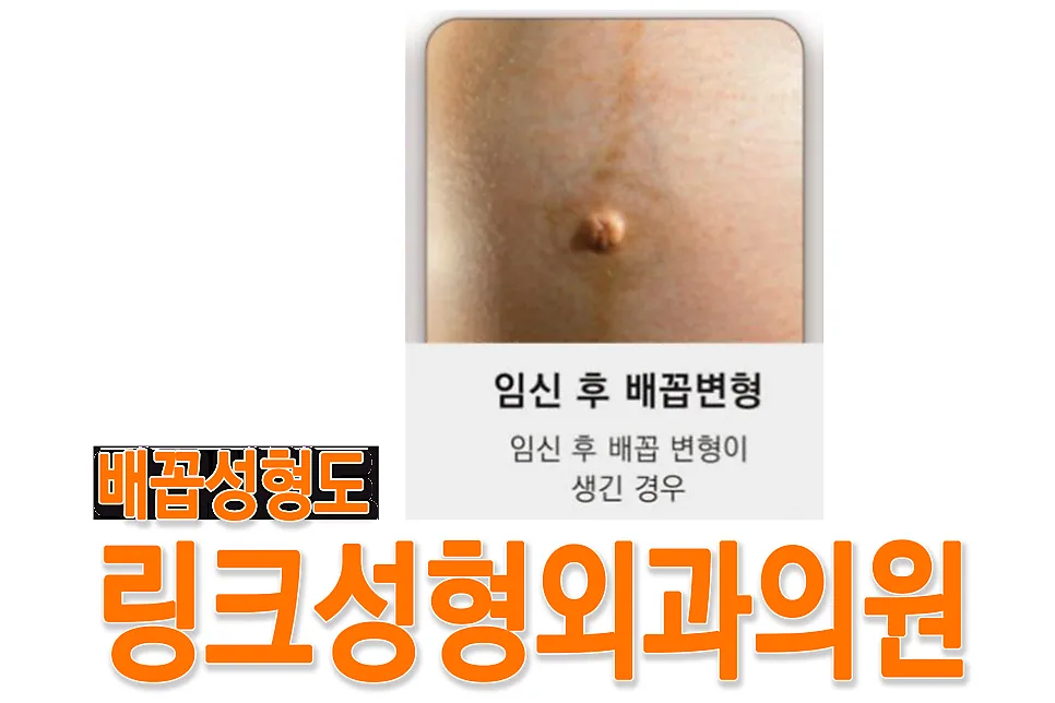 배꼽성형 관련 이미지