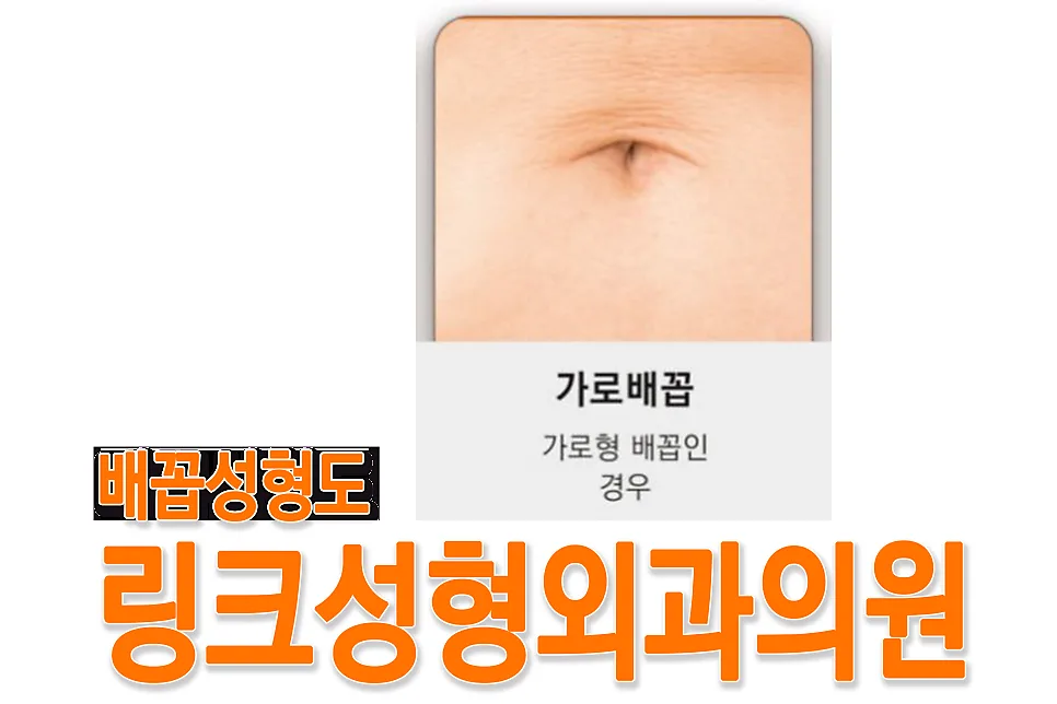 배꼽성형 관련 이미지
