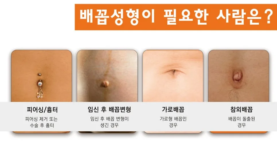 배꼽성형 관련 이미지