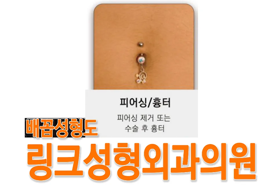 배꼽성형 관련 이미지