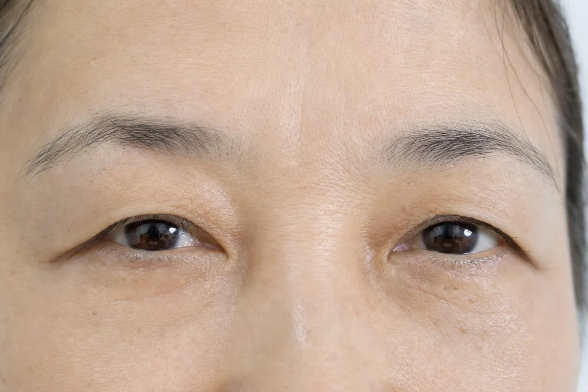 상안검 관련 이미지