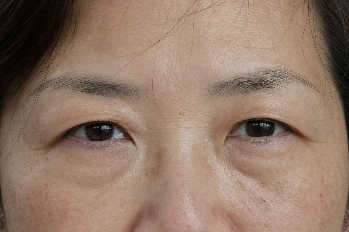 하안검 관련 이미지