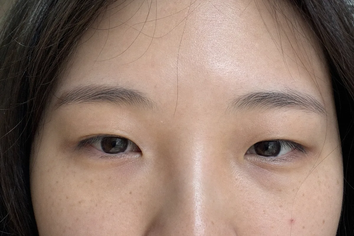 쌍꺼풀눈매교정 관련 이미지