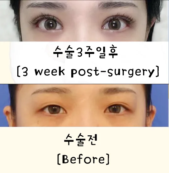 눈매교정 관련 이미지