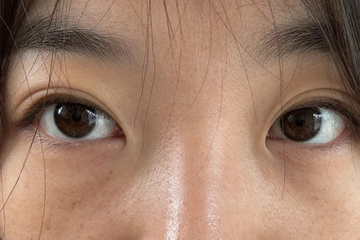 앞트임복원 관련 이미지