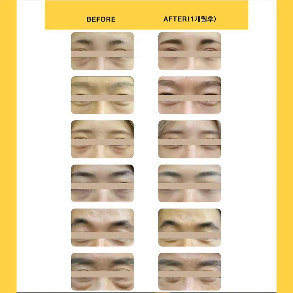 눈밑지방재배치 관련 이미지