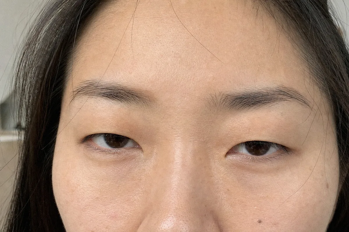 안검하수 관련 이미지