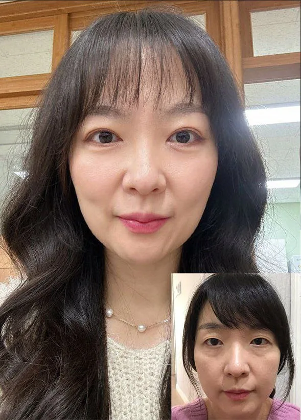 눈밑지방재배치 관련 이미지