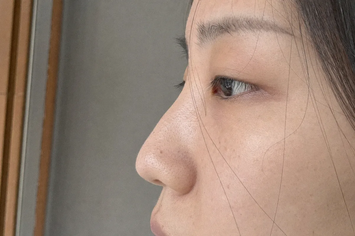 코보형물 관련 이미지