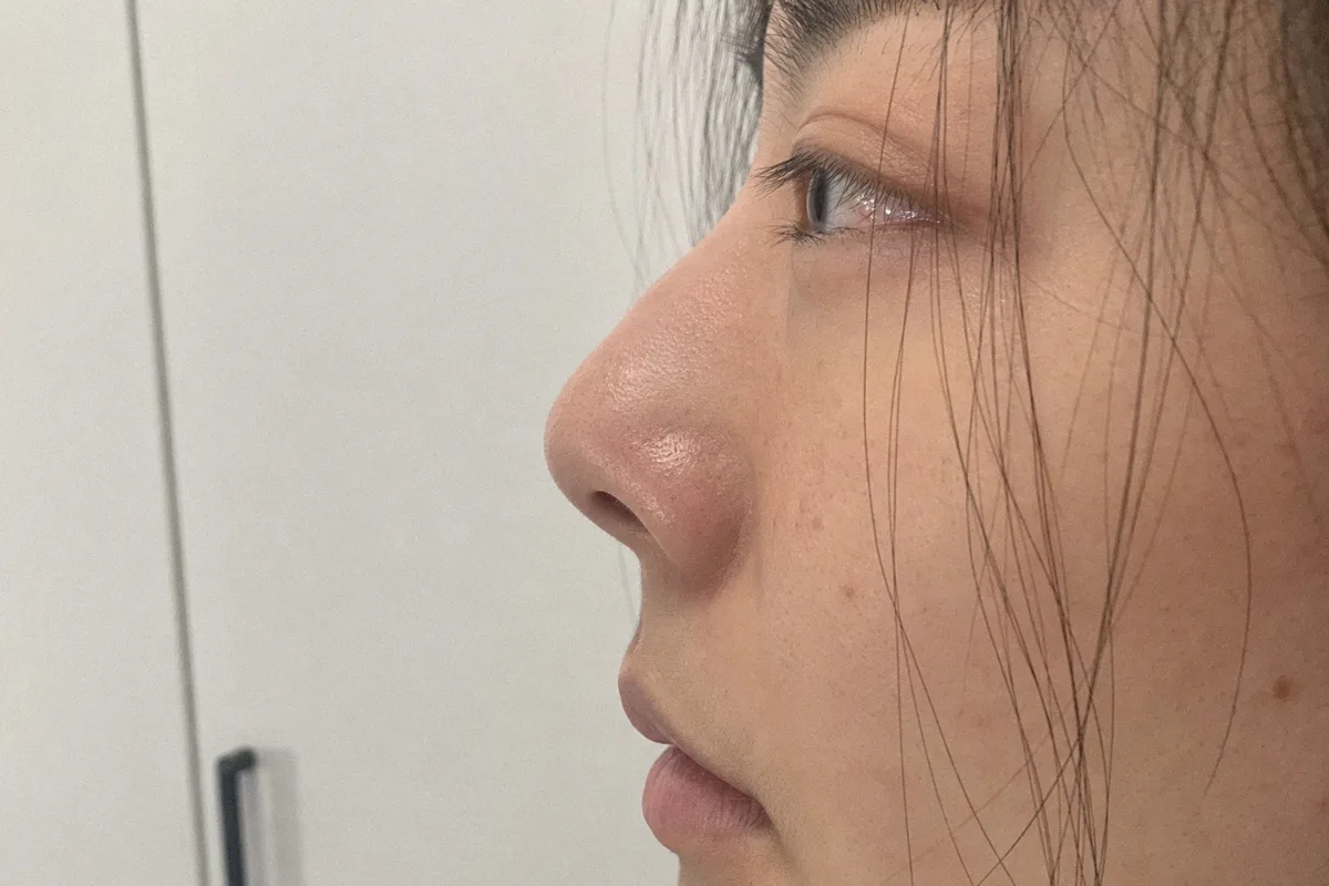 코재수술 관련 이미지
