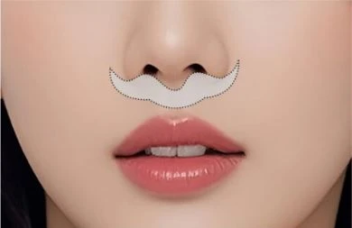 일반 인중축소 절개 방식