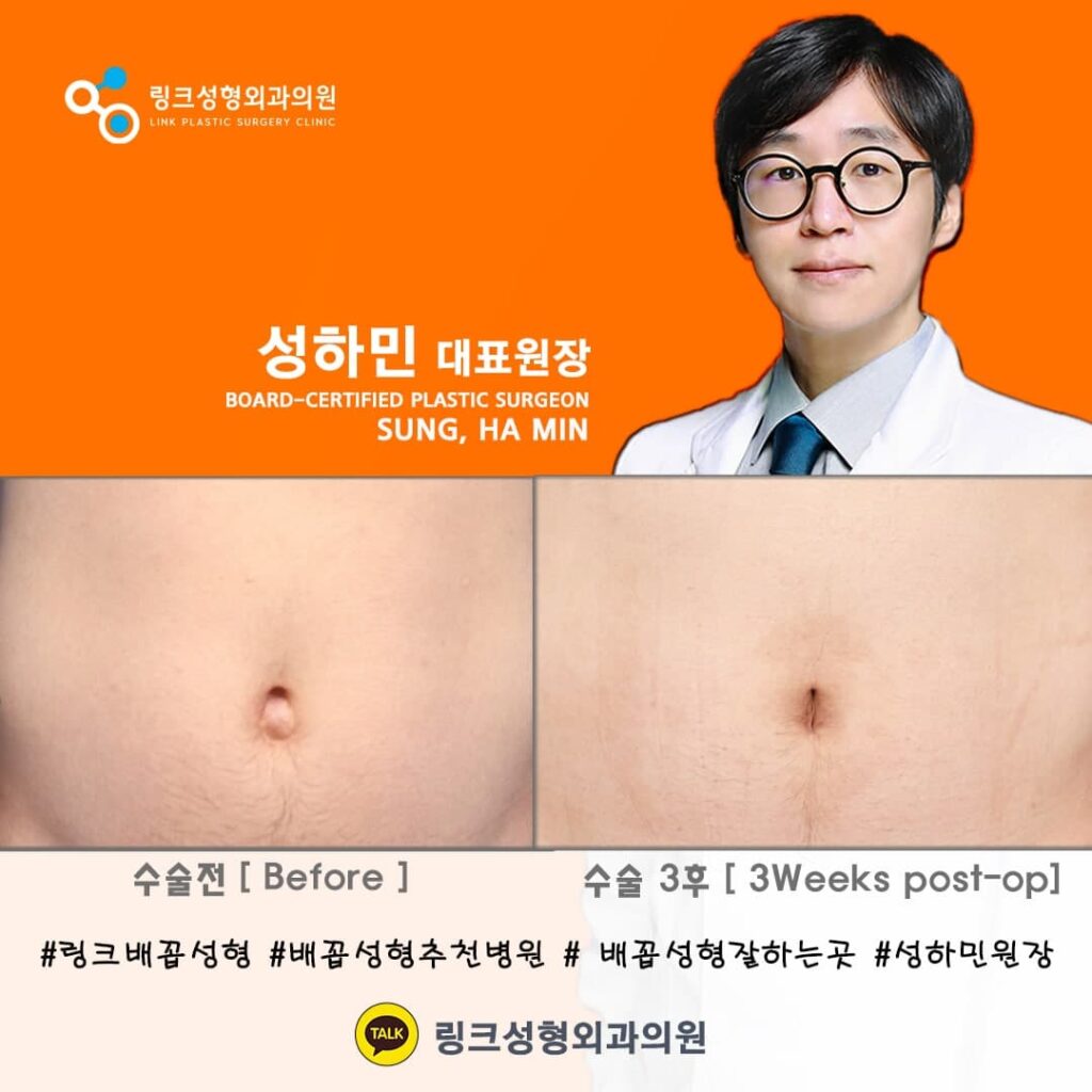 배꼽성형_리얼후기_성하민원장_성하민_링크성형외과_5