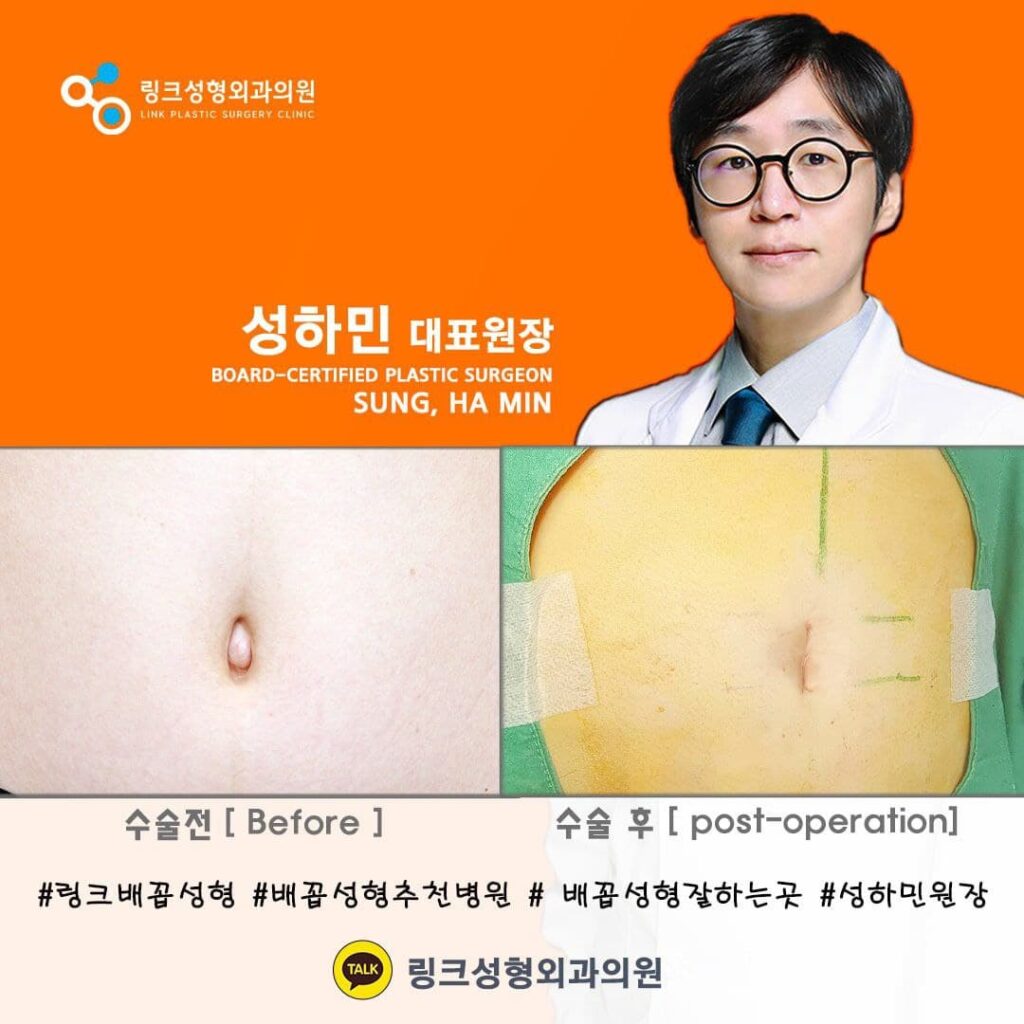 배꼽성형_배꼽수술_링크성형외과_성하민원장_4