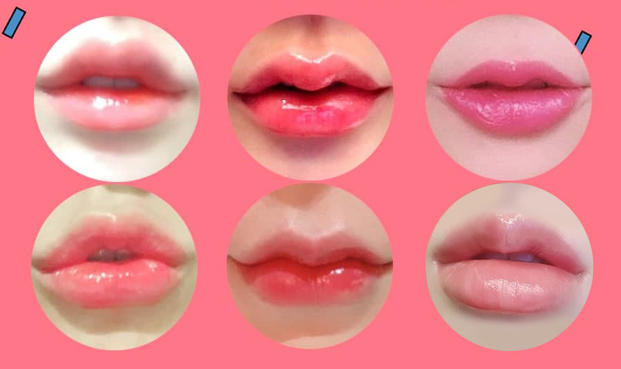 입술후기_링크성형외과_성하민원장_정민수원장_입술필러_테이스티입술필러