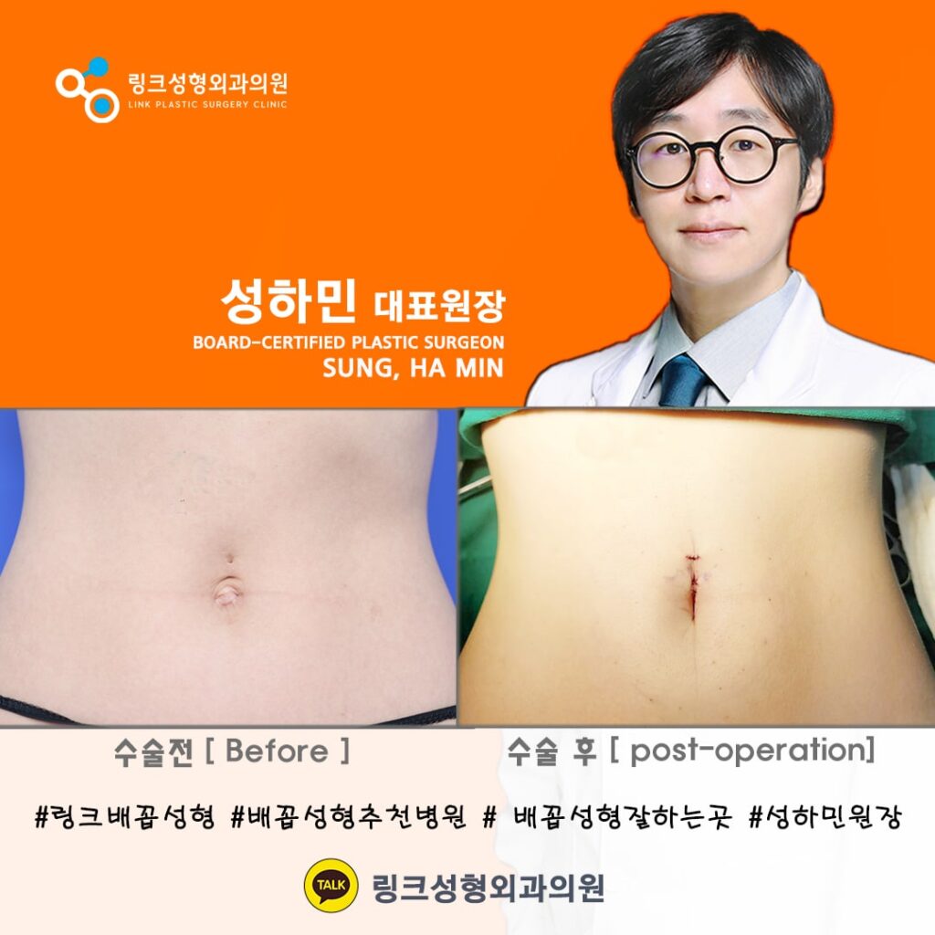 배꼽성형_배꼽수술_배꼽성형방법_링크성형외과_성하민원장_30