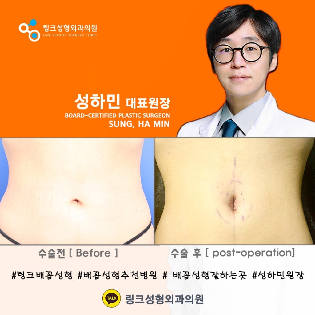 배꼽성형_배꼽수술_배꼽성형방법_링크성형외과_성하민원장_36