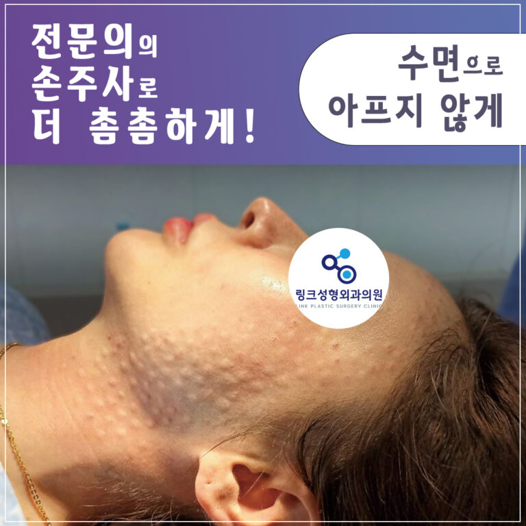 리쥬란_리쥬란힐러_수면리쥬란_리쥬란효과_리쥬란비용_1_리쥬란 실제 후기