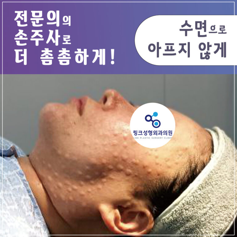 리쥬란_리쥬란힐러_수면리쥬란_리쥬란효과_리쥬란비용_3_리쥬란 실제 후기