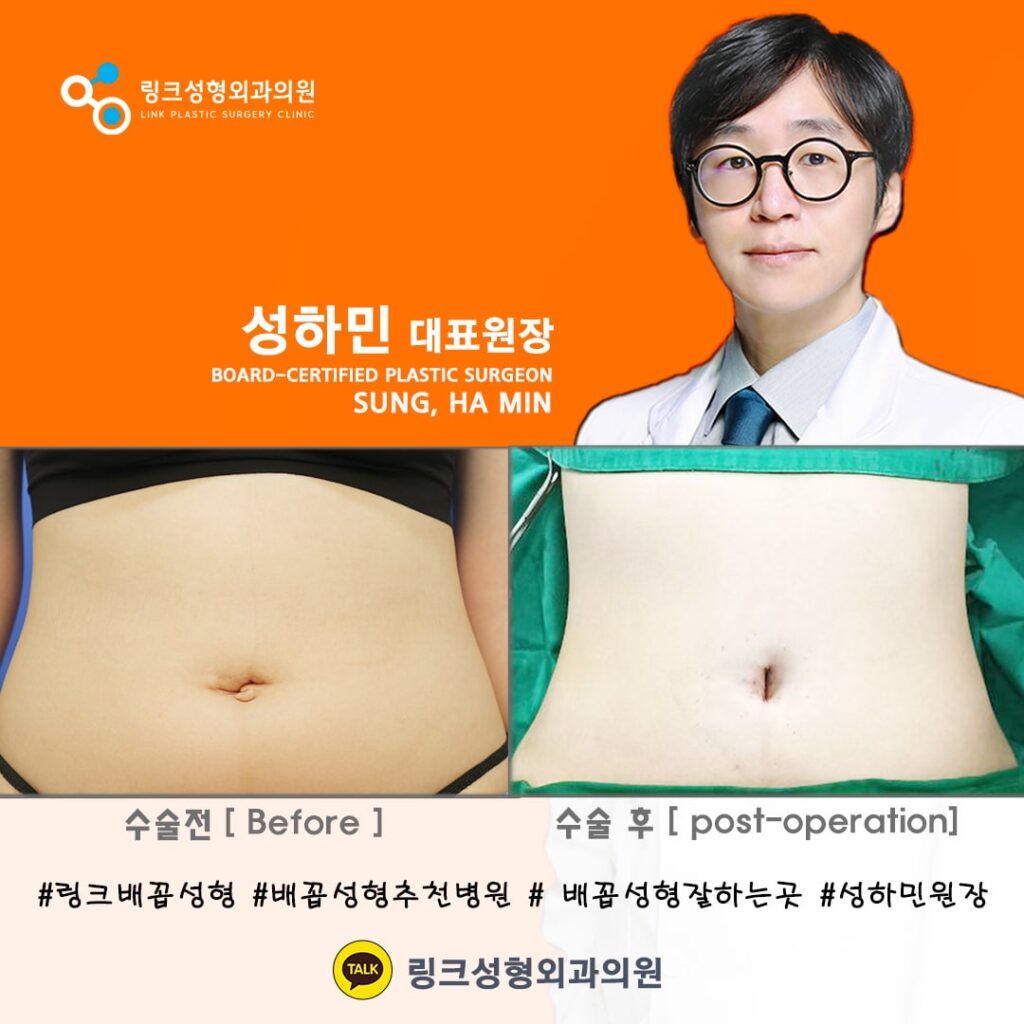 배꼽성형_배꼽수술_배꼽성형방법_링크성형외과_성하민원장_61