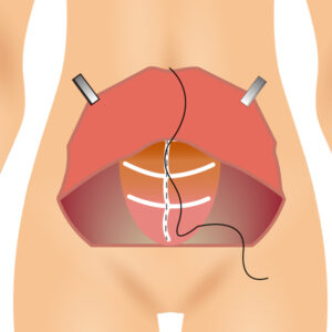 미니복부 절개-1_링크성형외과_성하민원장_정민수원장_2