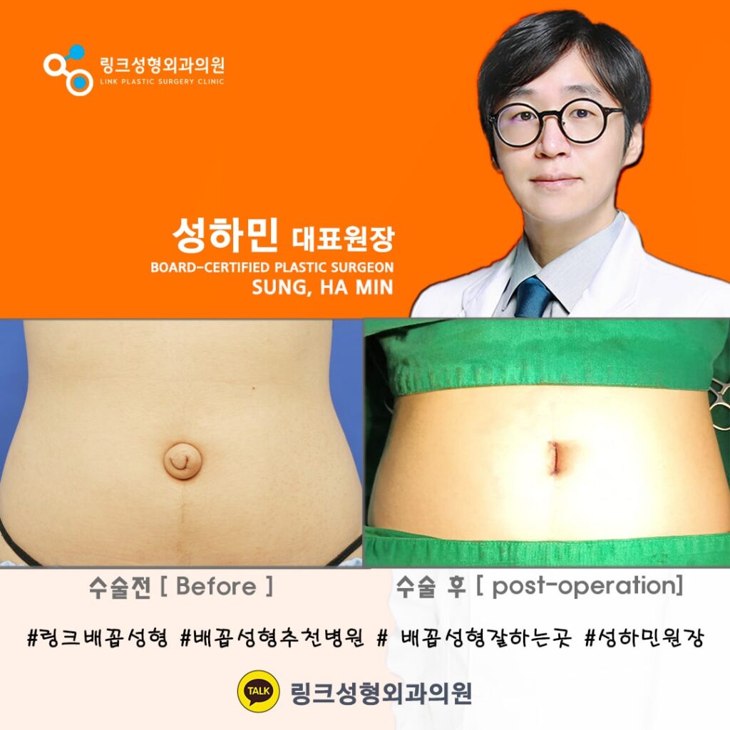 배꼽성형_배꼽수술_배꼽성형방법_링크성형외과_성하민원장_51