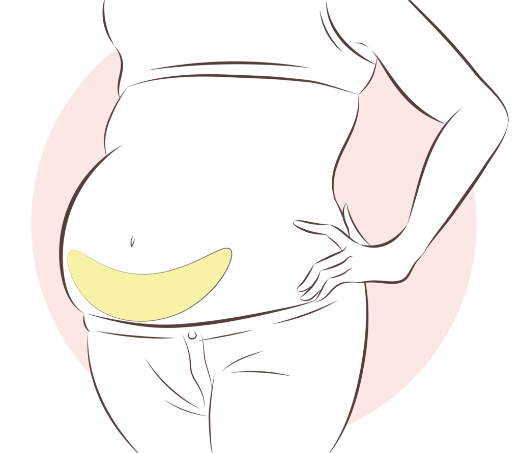 복부성형-미니절개_링크성형외과_성하민원장_정민수원장