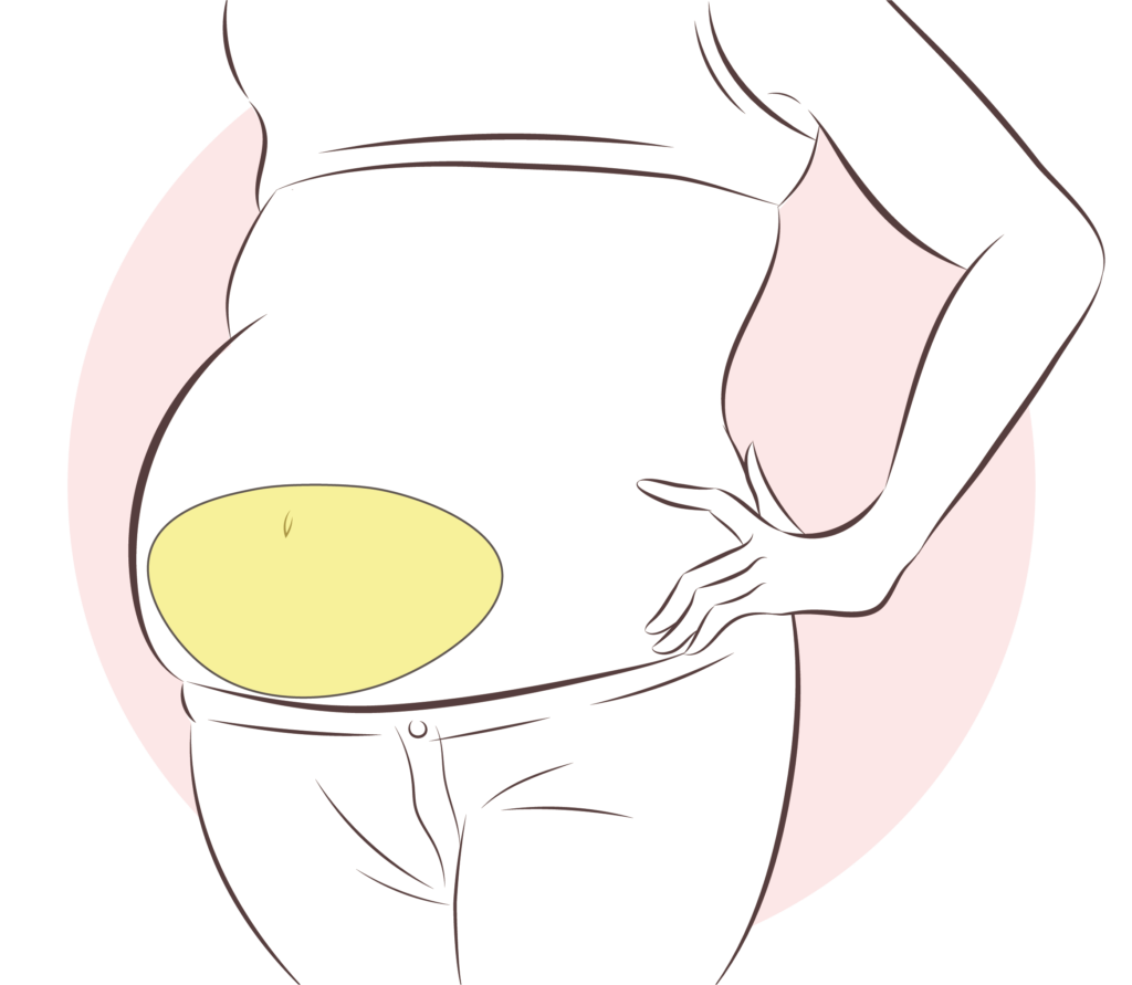 복부성형-전체절개_링크성형외과_성하민원장_정민수원장