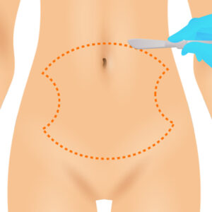 전체복부성형_링크성형외과_성하민원장_정민수원장_1